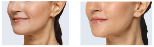 Restylane Lyft Before and After | skin care | Novique Medical Aesthetics | Doylestown, PA