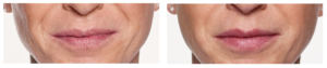 Restylane Silk Before and After | skin care | Novique Medical Aesthetics | Doylestown, PA