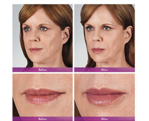 Juvederm volbella | skin care | Novique Medical Aesthetics | Doylestown, PA