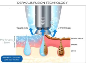 dermalinfusion | skin care | Novique Medical Aesthetics | Doylestown, PA