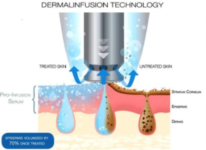 dermalinfusion | skin care | Novique Medical Aesthetics | Doylestown, PA