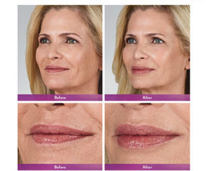 juederm volbella xc before and after | skin care | Novique Medical Aesthetics | Doylestown, PA