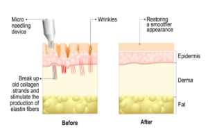 Microneedling PRP | skin care | Novique Medical Aesthetics | Doylestown, PA