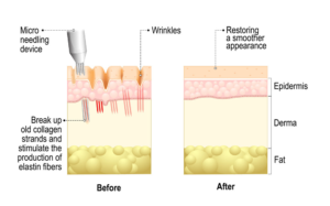 Microneedling PRP | skin care | Novique Medical Aesthetics | Doylestown, PA