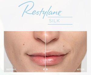 Restylane Silk Treatment | skin care | Novique Medical Aesthetics | Doylestown, PA
