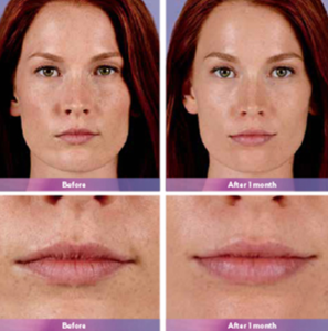 Juvederm Ultra Plus XC | skin care | Novique Medical Aesthetics | Doylestown, PA