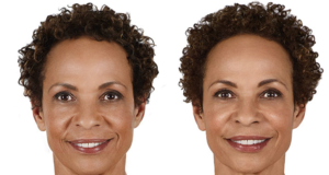 Juvederm Ultra Plus XC Before and After | skin care | Novique Medical Aesthetics | Doylestown, PA