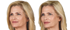 Juvederm Ultra Plus XC Before and After | skin care | Novique Medical Aesthetics | Doylestown, PA