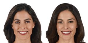 Juvederm Ultra Plus XC Before and After | skin care | Novique Medical Aesthetics | Doylestown, PA