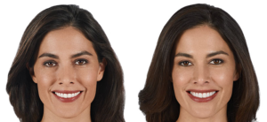 Juvederm Ultra Plus XC Before and After | skin care | Novique Medical Aesthetics | Doylestown, PA