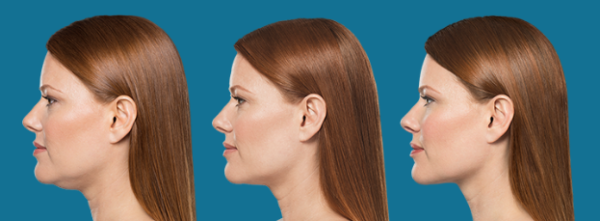 Kybella Before and After | skin care | Novique Medical Aesthetics | Doylestown, PA