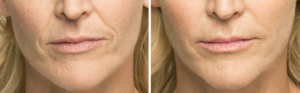 Belotero Result Before and After | skin care | Novique Medical Aesthetics | Doylestown, PA