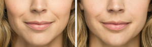 Belotero Before and After | skin care | Novique Medical Aesthetics | Doylestown, PA