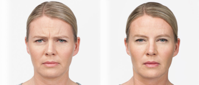 Botox Before & After | skin care | Novique Medical Aesthetics | Doylestown, PA