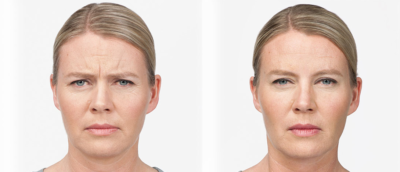 Botox Before & After Doylestown & Bucks County, PA Botox Before & After | skin care | Novique Medical Aesthetics | Doylestown, PA