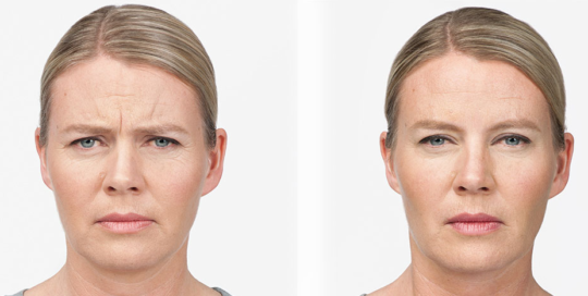 Botox Before & After | skin care | Novique Medical Aesthetics | Doylestown, PA