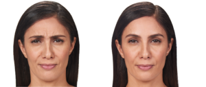 Botox Before & After | skin care | Novique Medical Aesthetics | Doylestown, PA