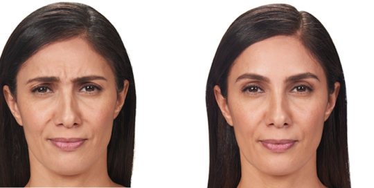Botox Before & After | skin care | Novique Medical Aesthetics | Doylestown, PA
