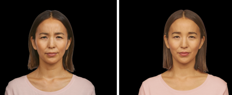 Jeuveau Before and After Doylestown & Bucks County, PA Jeuveau Before and Afte | skin care | Novique Medical Aesthetics | Doylestown, PA