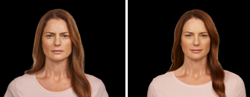 Jeuveau Before and After Doylestown & Bucks County, PA Jeuveau Before and After | skin care | Novique Medical Aesthetics | Doylestown, PA
