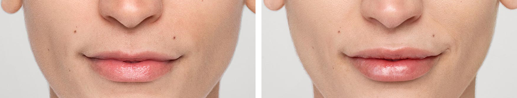 Restylane Silk Before and After | skin care | Novique Medical Aesthetics | Doylestown, PA