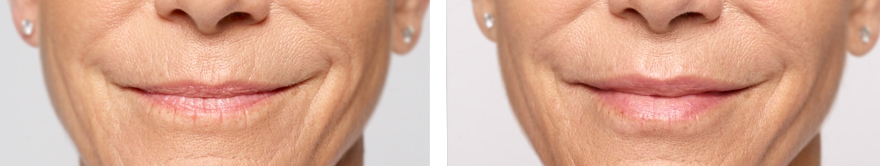 Restylane Silk Before and After | skin care | Novique Medical Aesthetics | Doylestown, PA