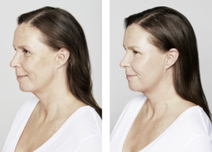 Restylane Line Before & After | skin care | Novique Medical Aesthetics | Doylestown, PA