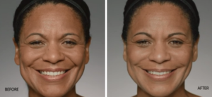 Restylane Defyne Before and After | skin care | Novique Medical Aesthetics | Doylestown, PA