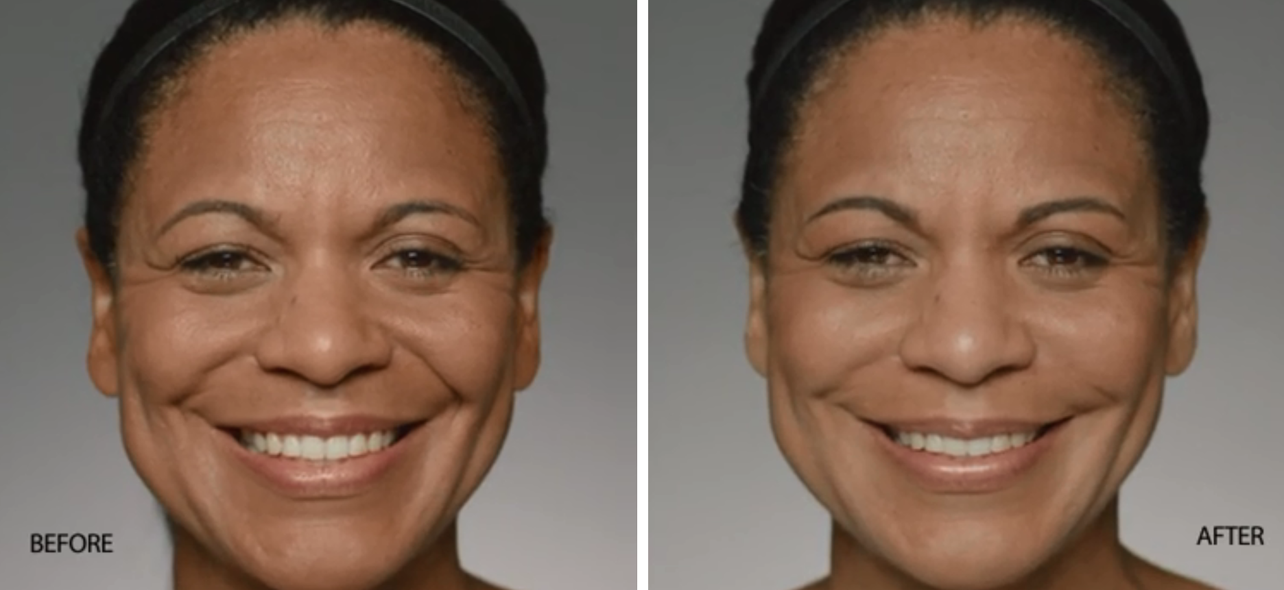 Restylane Defyne Before and After | skin care | Novique Medical Aesthetics | Doylestown, PA