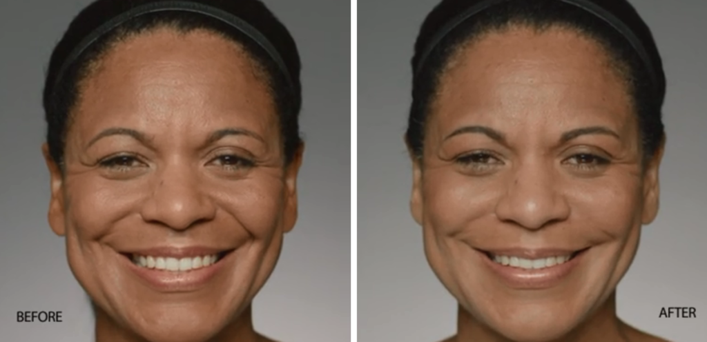 Restylane Refyne | skin care | Novique Medical Aesthetics | Doylestown, PA