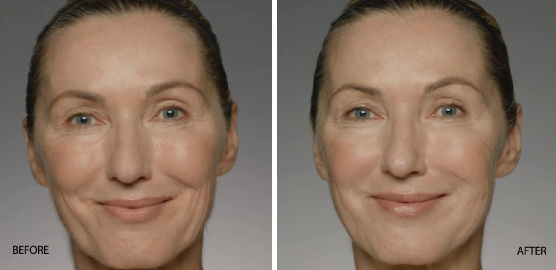 Restylane Refyne Before and After | skin care | Novique Medical Aesthetics | Doylestown, PA