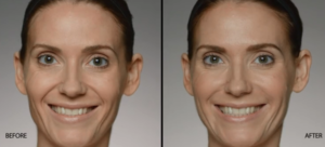 Restylane Defyne Before and After | skin care | Novique Medical Aesthetics | Doylestown, PA