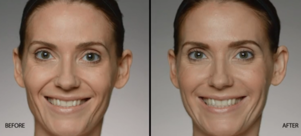 Restylane Defyne Before and After | skin care | Novique Medical Aesthetics | Doylestown, PA