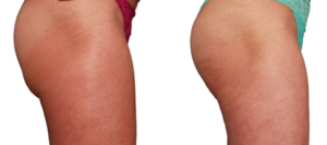 Venus Legacy Before and After | skin care | Novique Medical Aesthetics | Doylestown, PA