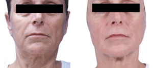 Venus Legacy Before and After | skin care | Novique Medical Aesthetics | Doylestown, PA