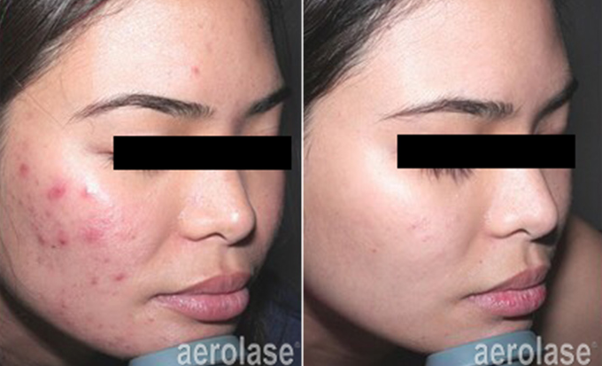 Aerolase Before and After Doylestown & Bucks County, PA Acne Treatment | skin care | Novique Medical Aesthetics | Doylestown, PA