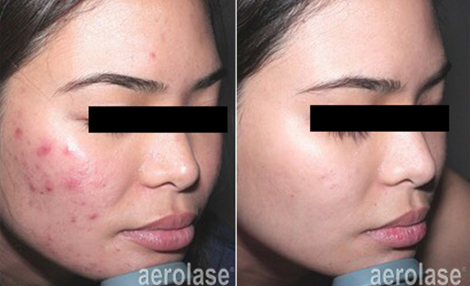 Acne Treatment | skin care | Novique Medical Aesthetics | Doylestown, PA