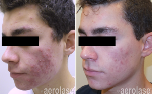 Aerolase Before and After | skin care | Novique Medical Aesthetics | Doylestown, PA