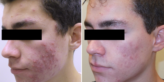 Aerolase Before and After | skin care | Novique Medical Aesthetics | Doylestown, PA