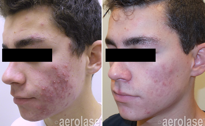 Aerolase Before and After Doylestown & Bucks County, PA Aerolase Before and After | skin care | Novique Medical Aesthetics | Doylestown, PA