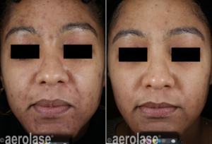 Aerolase Before and After | skin care | Novique Medical Aesthetics | Doylestown, PA