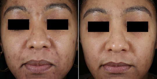 Aerolase Before and After | skin care | Novique Medical Aesthetics | Doylestown, PA