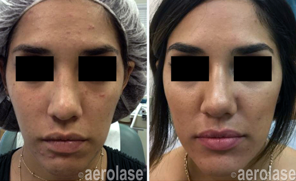 Aerolase Before and After Doylestown & Bucks County, PA Aerolase Before and After | skin care | Novique Medical Aesthetics | Doylestown, PA