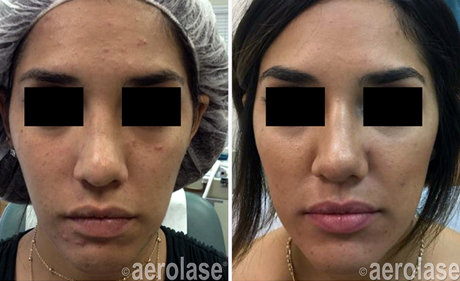 Aerolase Before and After | skin care | Novique Medical Aesthetics | Doylestown, PA