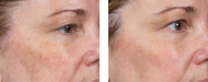 Clear + Brilliant | skin care | Novique Medical Aesthetics | Doylestown, PA