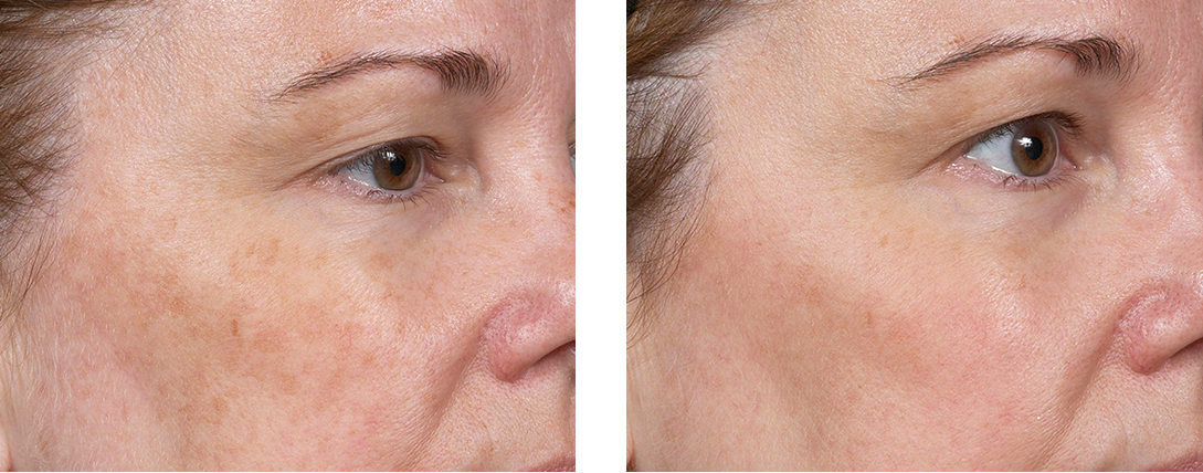 Clear + Brilliant | skin care | Novique Medical Aesthetics | Doylestown, PA