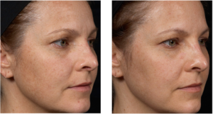 Clear + Brilliant Before and After | skin care | Novique Medical Aesthetics | Doylestown, PA