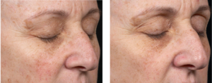 Clear + Brilliant Before and After | skin care | Novique Medical Aesthetics | Doylestown, PA