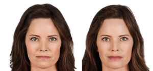 Juvederm Ultra Plus XC Before and After | skin care | Novique Medical Aesthetics | Doylestown, PA