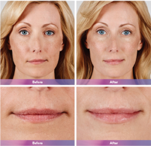 Juvederm Ultra Plus XC Before and After | skin care | Novique Medical Aesthetics | Doylestown, PA